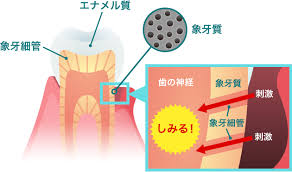 しみる！知覚過敏を見過ごさない！【大阪市都島区内の歯医者|アスヒカル歯科】