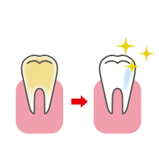 ホワイトニングを知ろう！Part2【大阪市都島区内の歯医者|アスヒカル歯科】