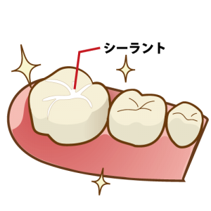 年長、小1のシーラント！【大阪市都島区内の歯医者|アスヒカル歯科】