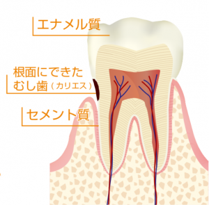 根面齲蝕について【大阪市都島区内の歯医者|アスヒカル歯科】