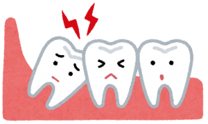 親知らずの抜歯【大阪市都島区内の歯医者|アスヒカル歯科】