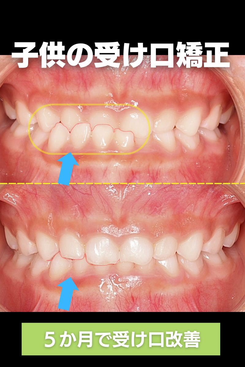 子供の受け口矯正治療
