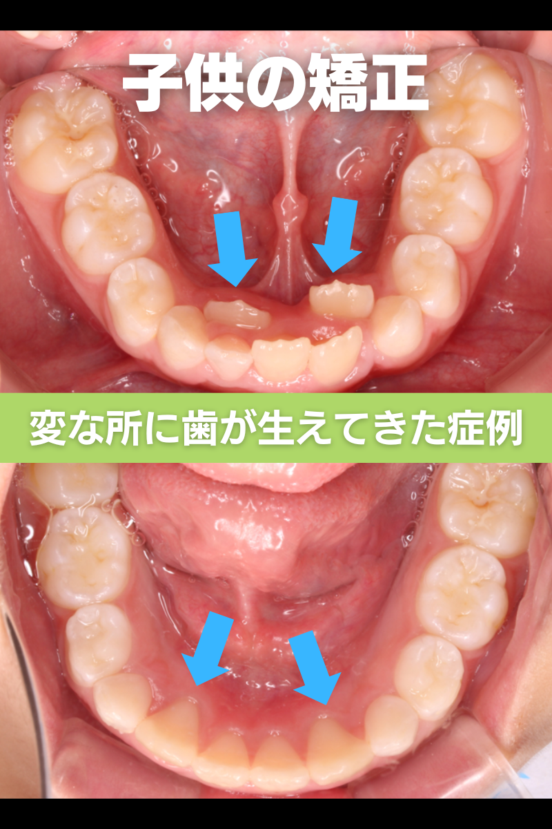 子供のインビザライン矯正