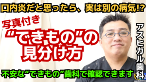 【歯茎のできもの】これって何？種類と原因、危険なサインを歯科医が解説