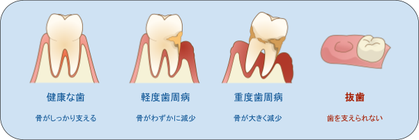 その症状、放置するほど歯を失うリスクが高まります