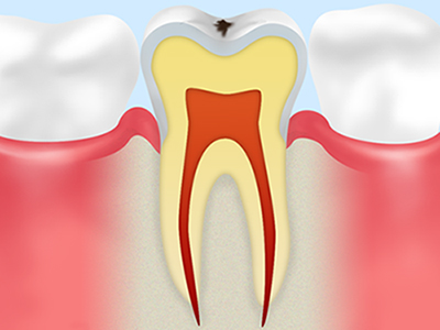 C1 エナメル質のむし歯