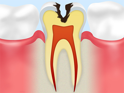 C3 神経まで侵されたむし歯