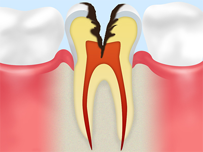 C4 歯冠が崩壊したむし歯