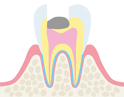 歯の神経を取りたくない（歯の神経を残したい）方へ