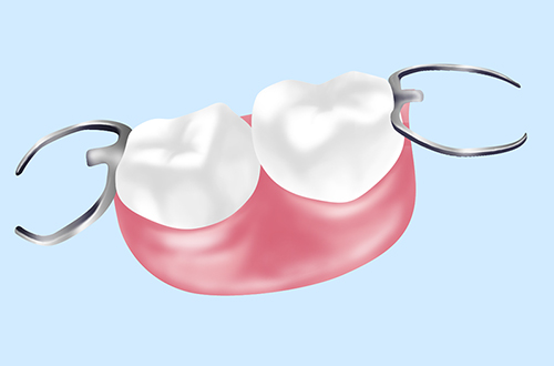 部分入れ歯