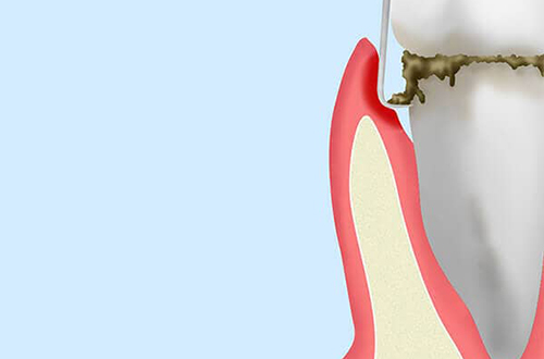 歯周ポケット掻爬術