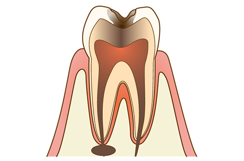①虫歯