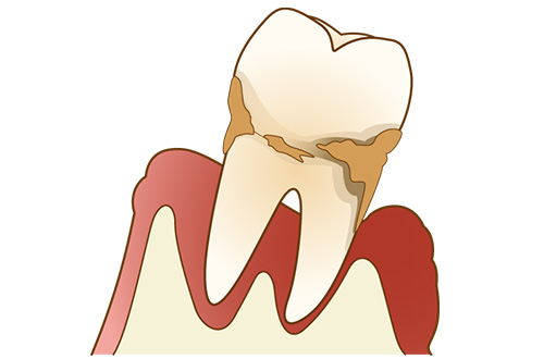 ②歯周病