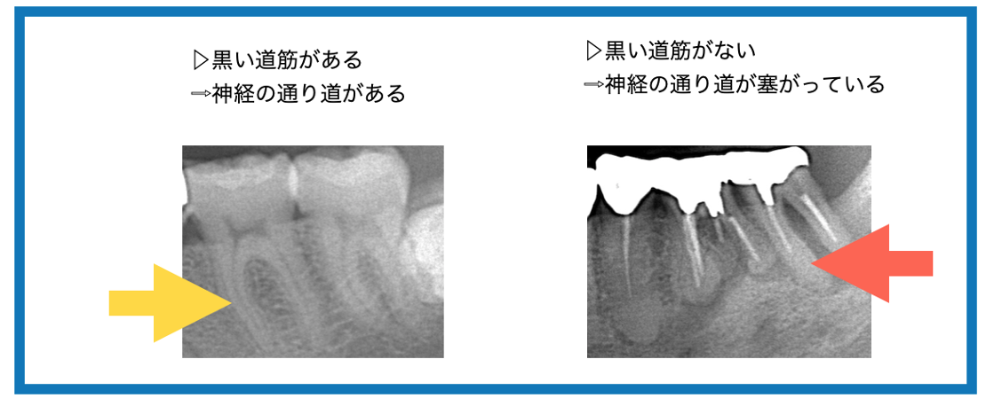 石灰化比較画像
