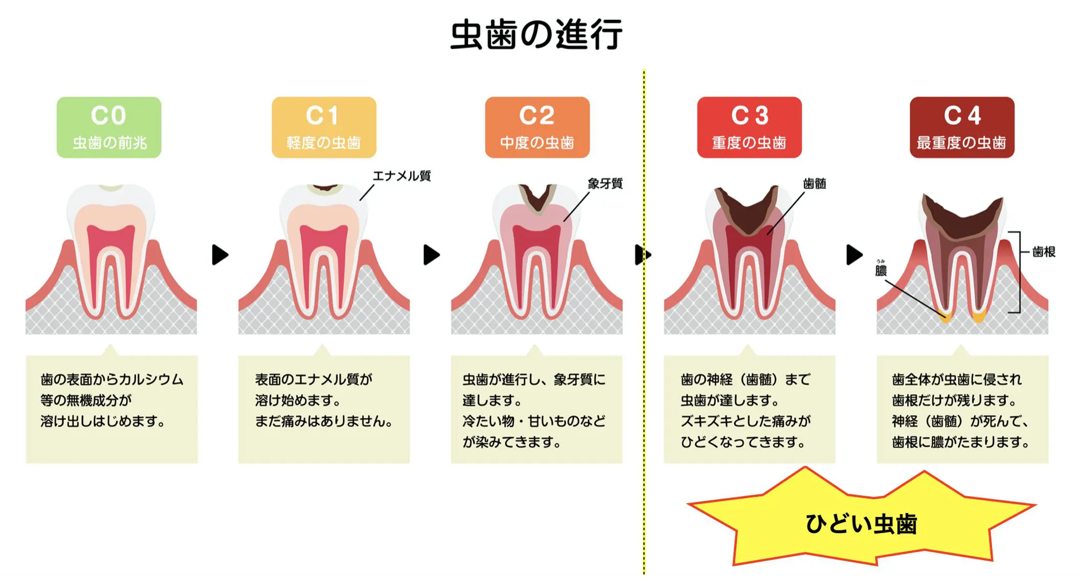 治療画像付き この虫歯はひどい状態 今後の治療の流れを解説 治療画像付き この虫歯はひどい状態 今後の治療の流れを解説