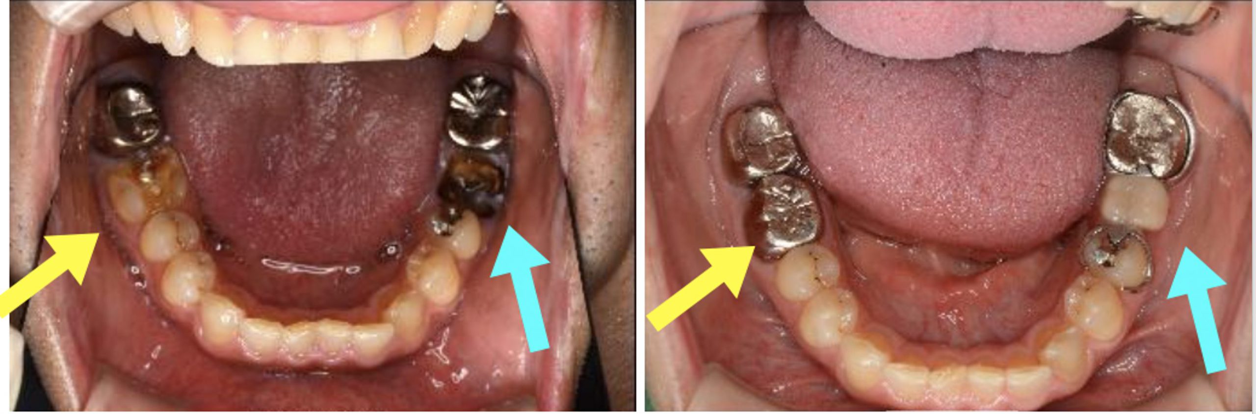 治療画像付き この虫歯はひどい状態 今後の治療の流れを解説 治療画像付き この虫歯はひどい状態 今後の治療の流れを解説