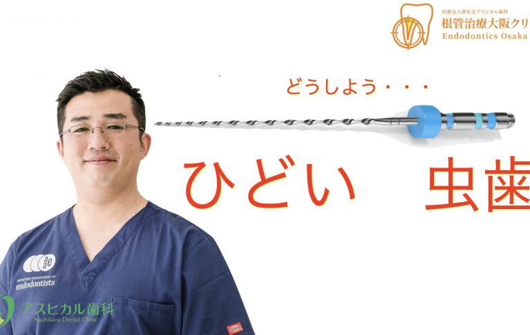 ひどい　虫歯