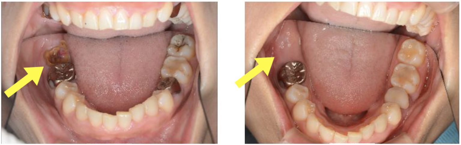 【治療画像付き】この虫歯はひどい状態？今後の治療の流れを解説！