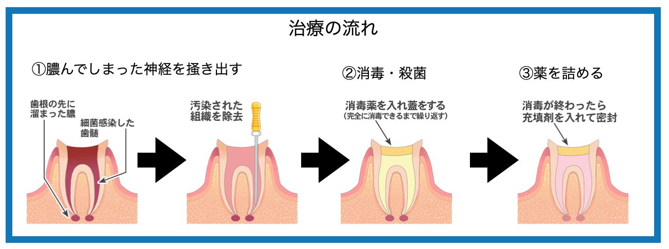 神経を取る手順画像
