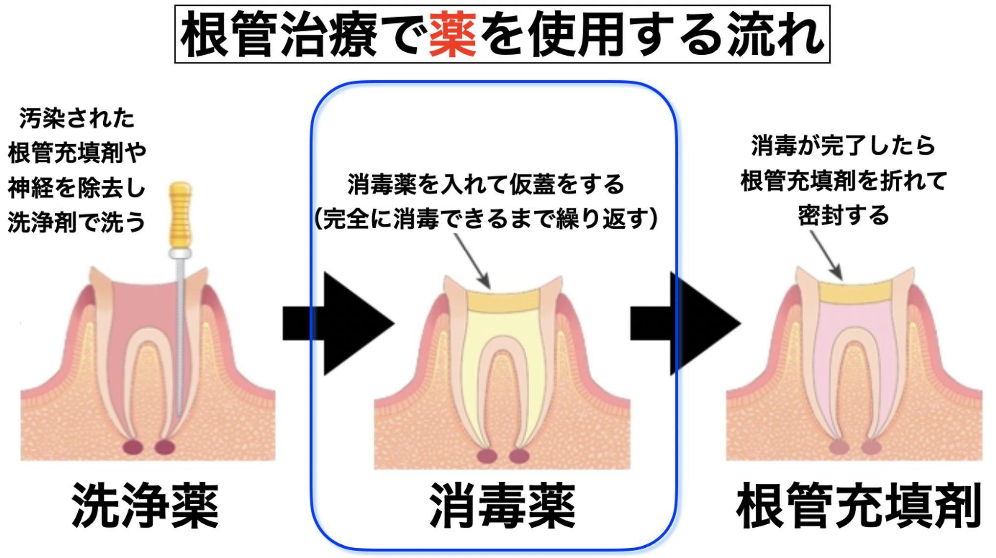 現役歯科医解説 根管治療の薬がもたらす不安や痛みの原因と対処法