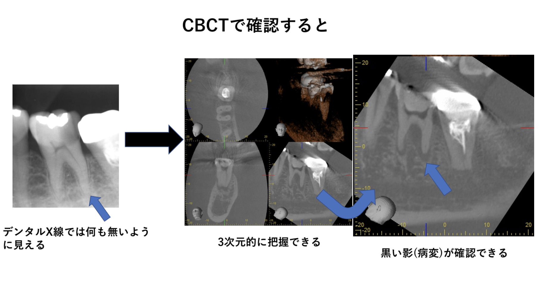 CBCT症例