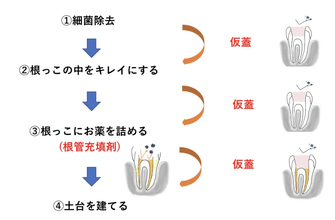 詰め物で成功が決まる 根管治療の詰め物を根管治療専門医が徹底解説 詰め物で成功が決まる 根管治療の詰め物を根管治療専門医が徹底解説
