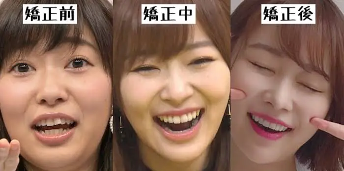 整形なみに美人になる 笑顔輝く歯列矯正 整形なみに美人になる 笑顔輝く歯列矯正