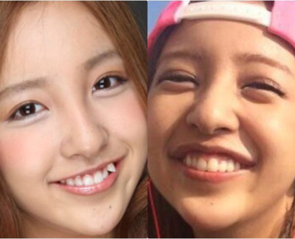 諦めないで 気になる八重歯を矯正治療 諦めないで 気になる八重歯を矯正治療