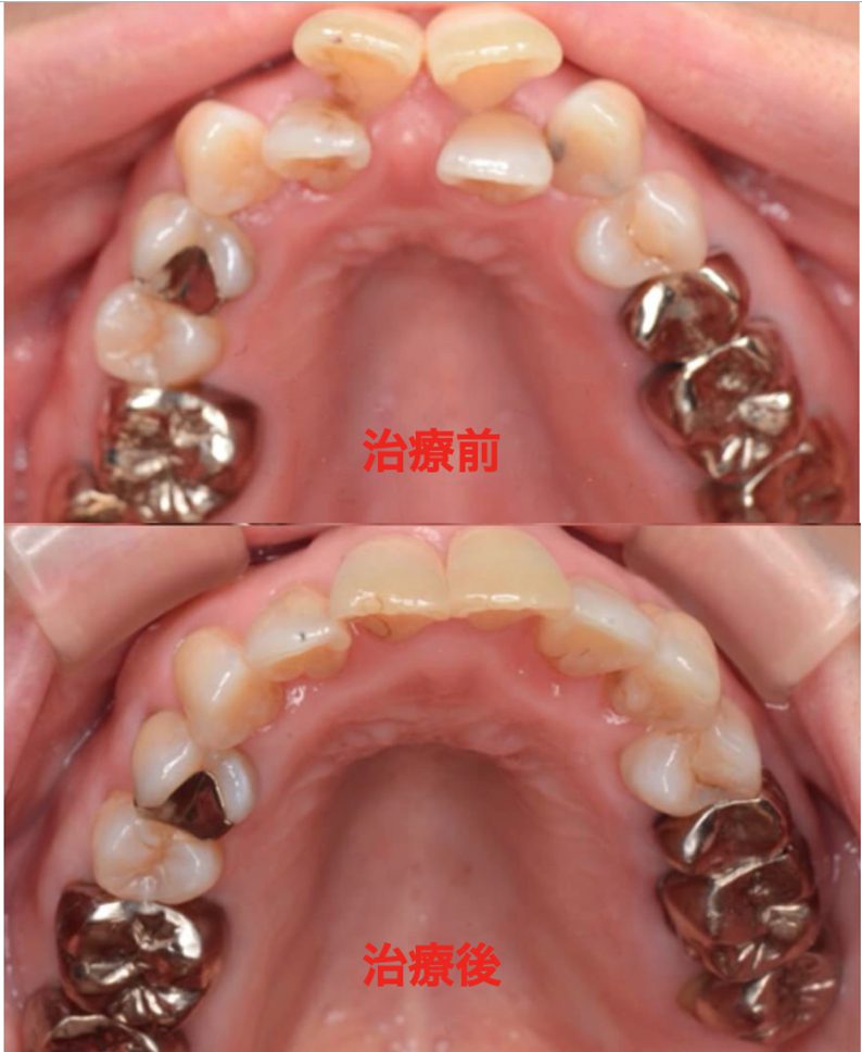 歯列矯正症例写真１