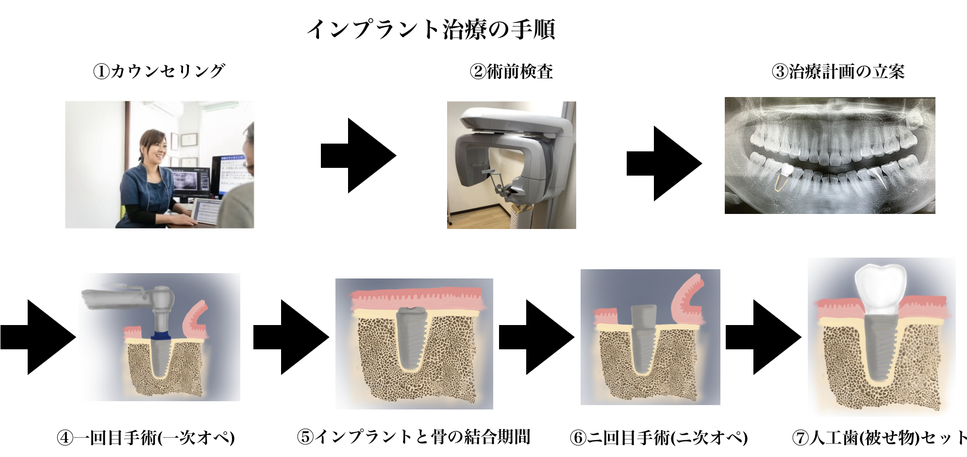 インプラントー手順1