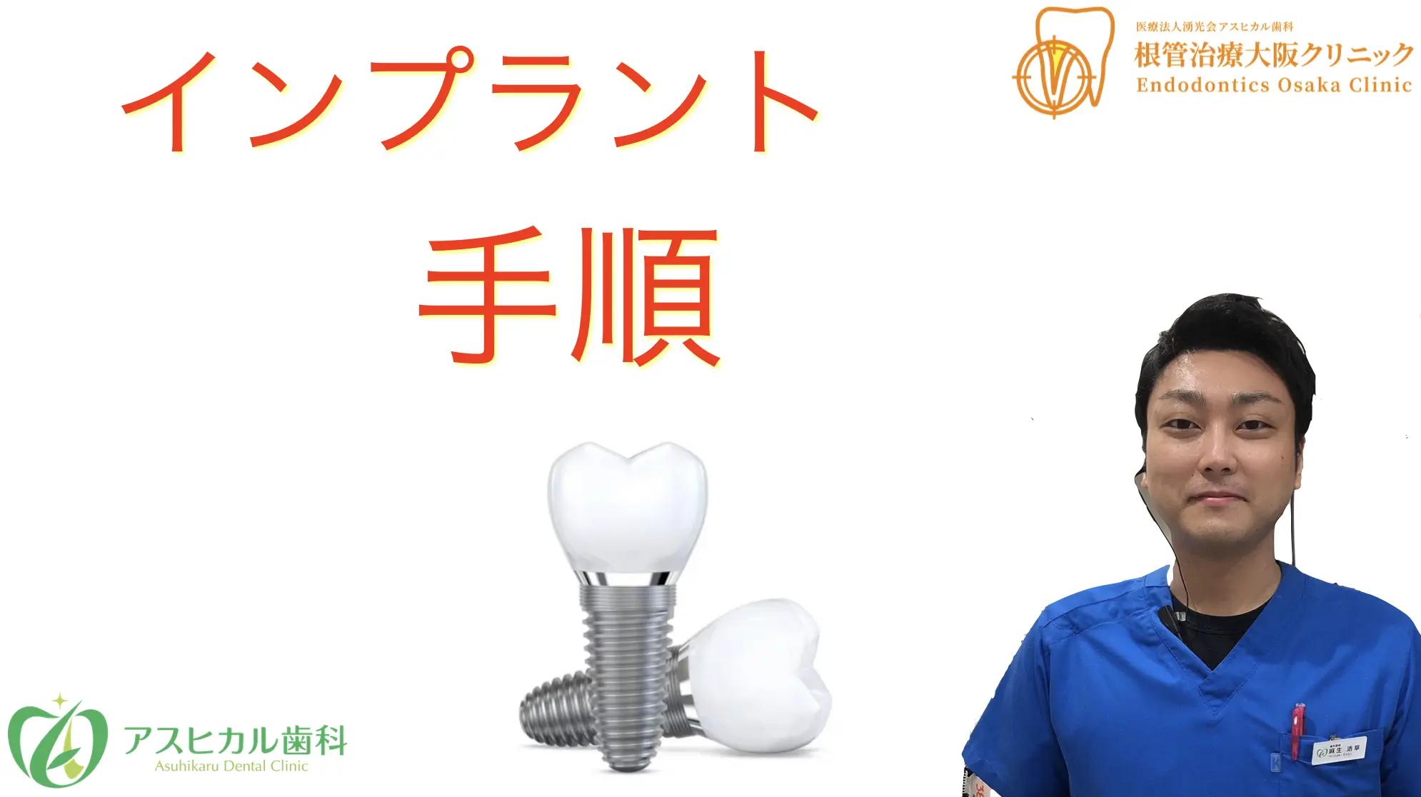これを読めば全てわかる！インプラント治療の手順・期間など徹底解説