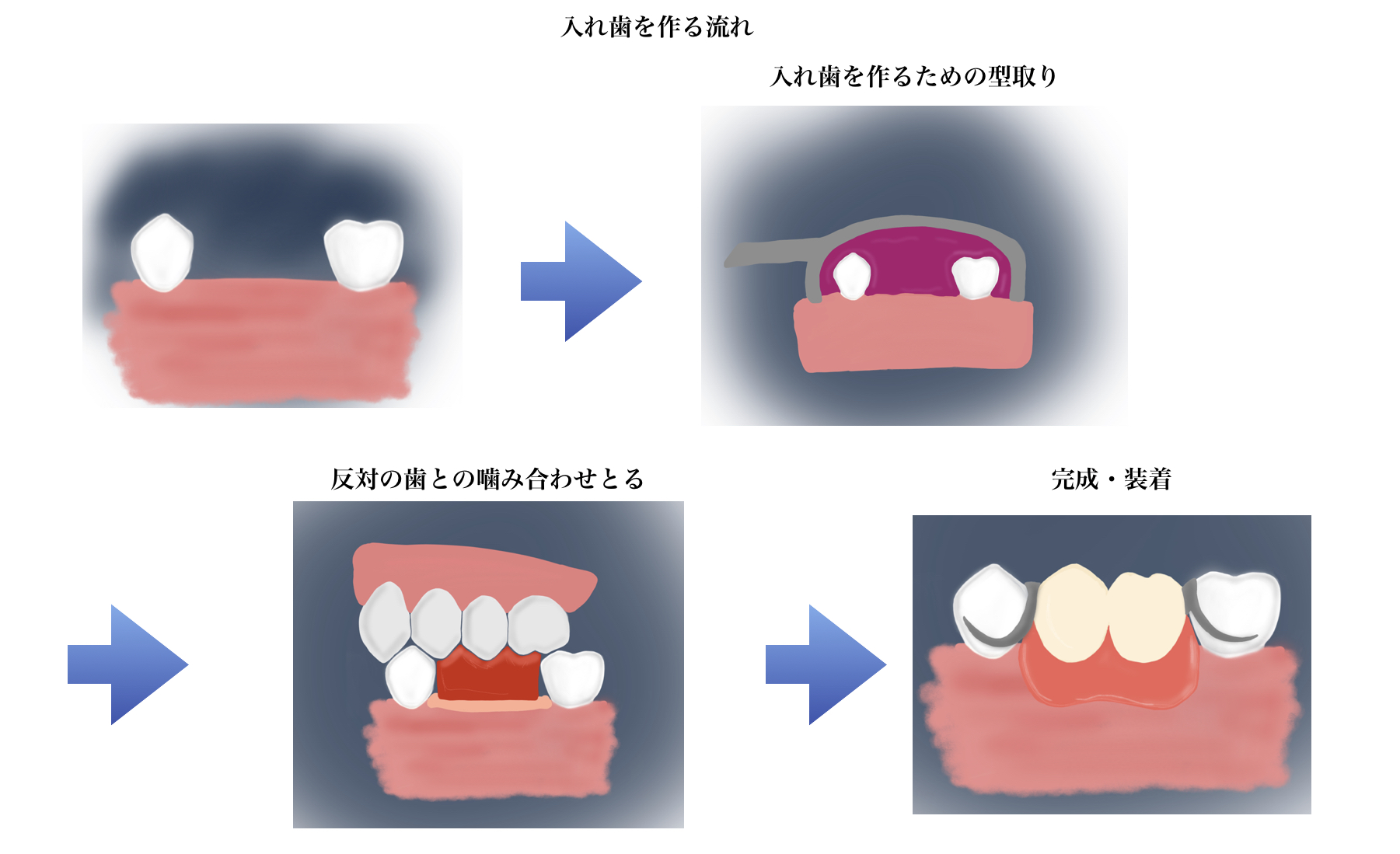 入れ歯とインプラント