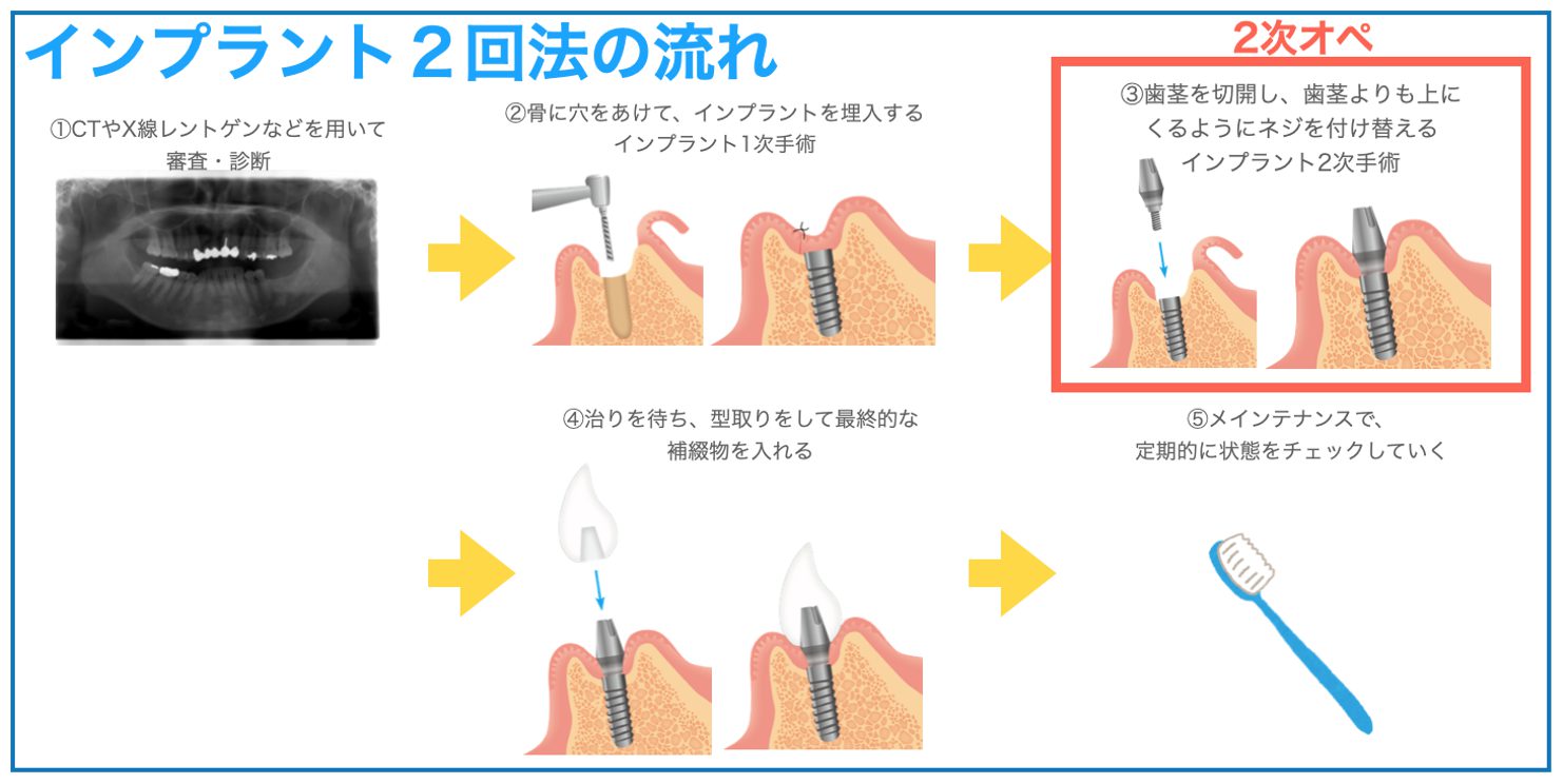 2回法の治療の流れ