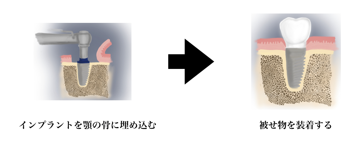 差し歯-インプラント3