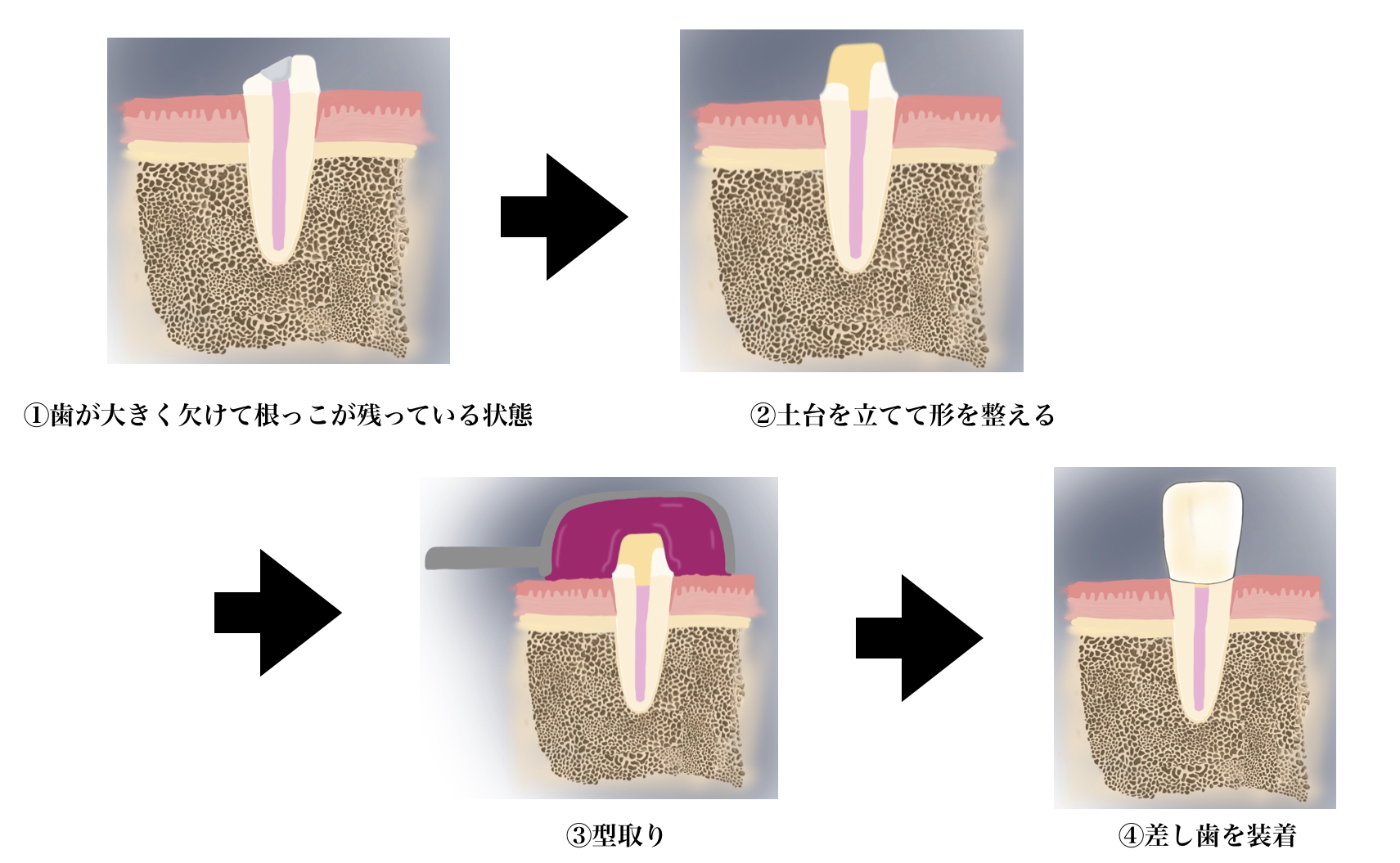 差し歯-インプラント5