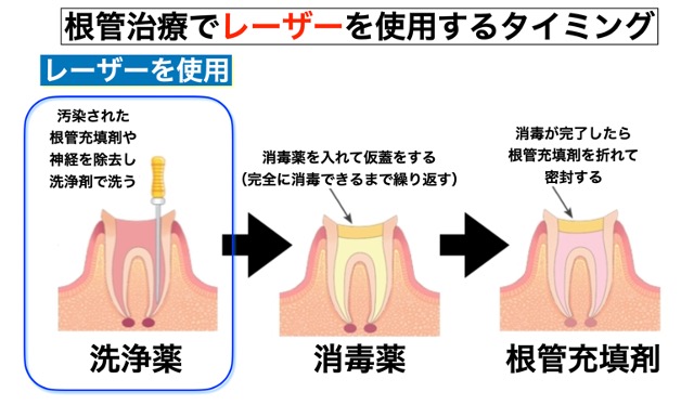 レーザー2