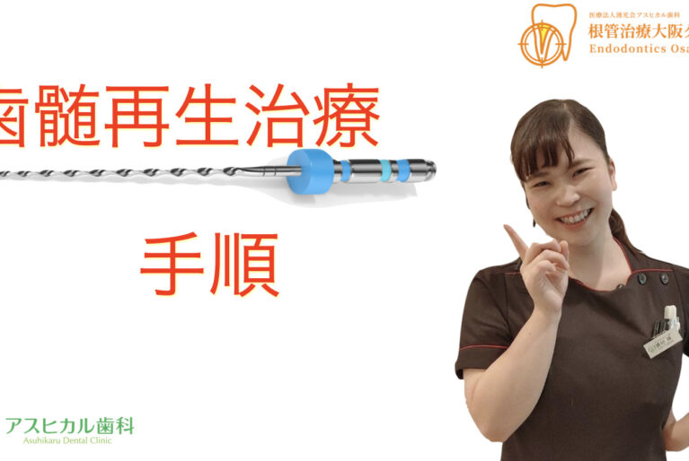 歯髄再生治療手順アイキャッチ画像