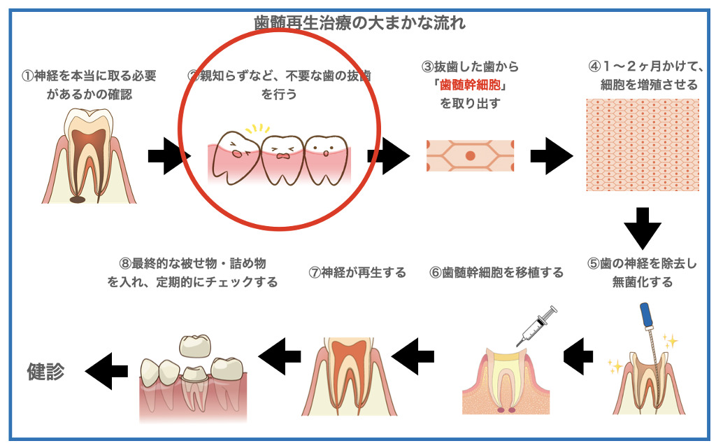 歯髄再生治療　抜歯丸印